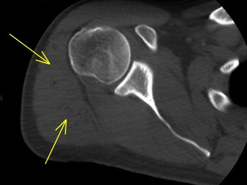 Figure 2 for case Axillary cyst and denervation